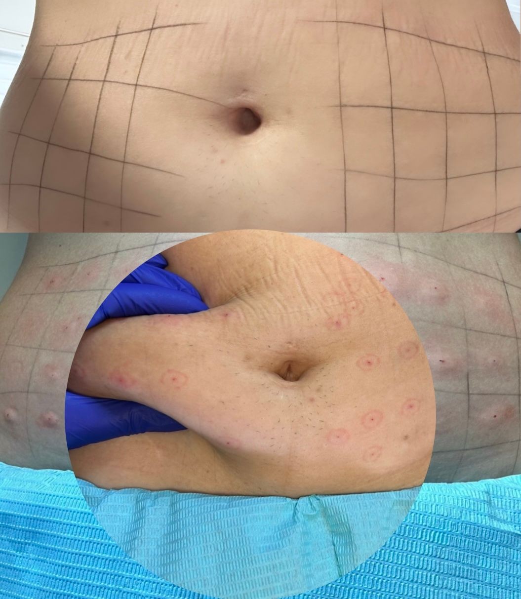 Servicio de Mesoterapia Presurizada